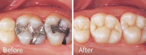 Before and after treatment with white fillings